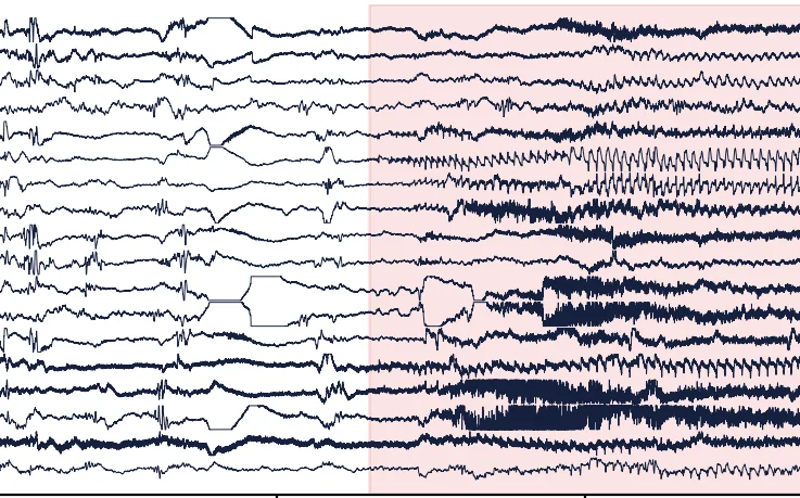Neonatal EEG traces in a bipolar montage, with the seizure period highlighted.